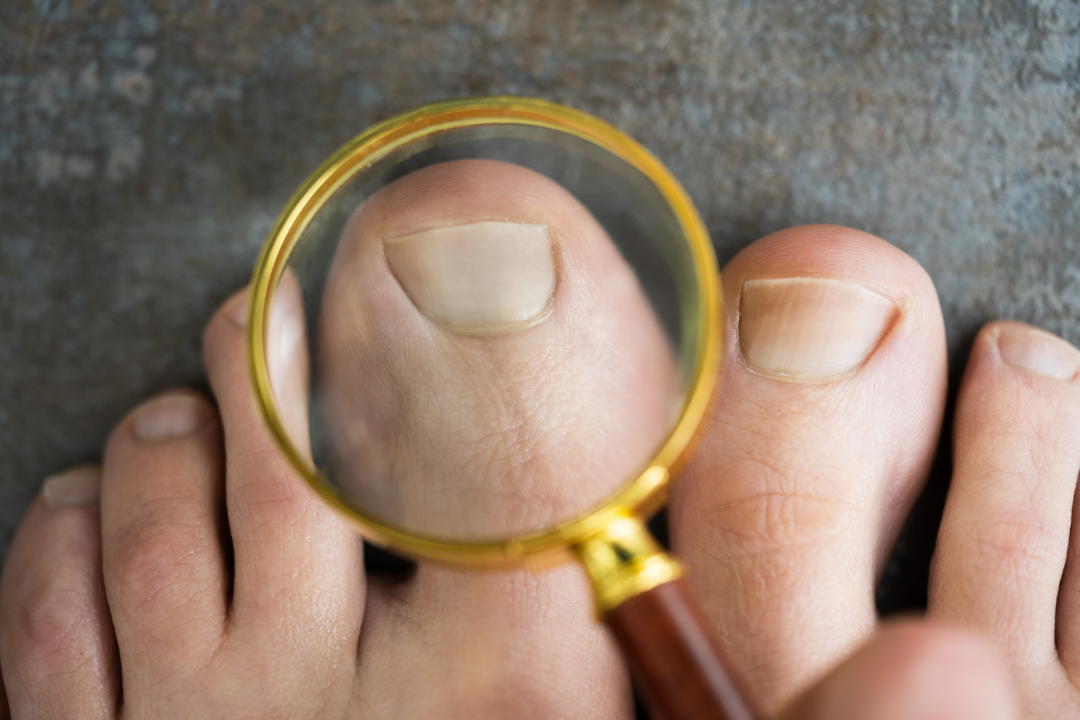 Debunking Ingrown Toenail Treatment Recommendations