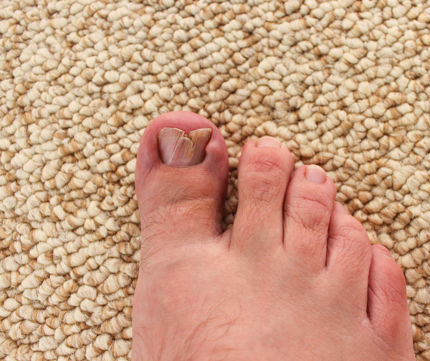 What Happens If You Ignore Your Ingrown Toenail?