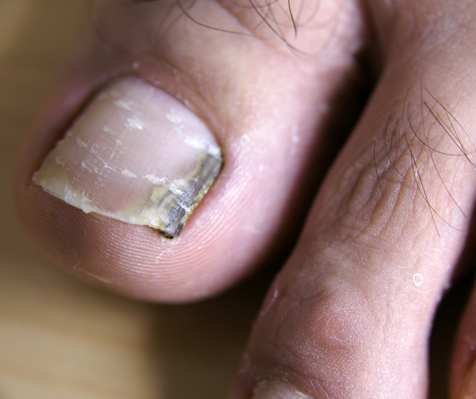 Signs Of A Melanoma Beneath Your Toenail