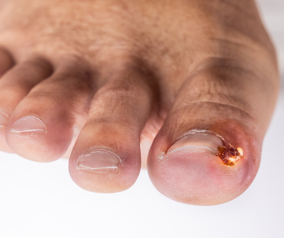 Your Ingrown Nail FAQs, Answered