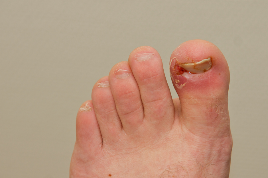 Do I Need Antibiotics For An Ingrown Nail?