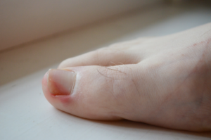 What Else Can The Auckland Ingrown Toenail Clinic Help You With?