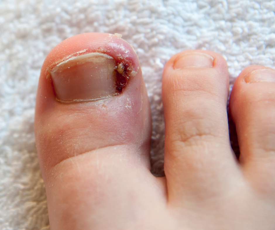 Is My Ingrown Toenail Infected?