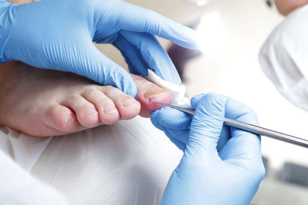 Caring For Your Ingrown Toenails After Nail Surgery