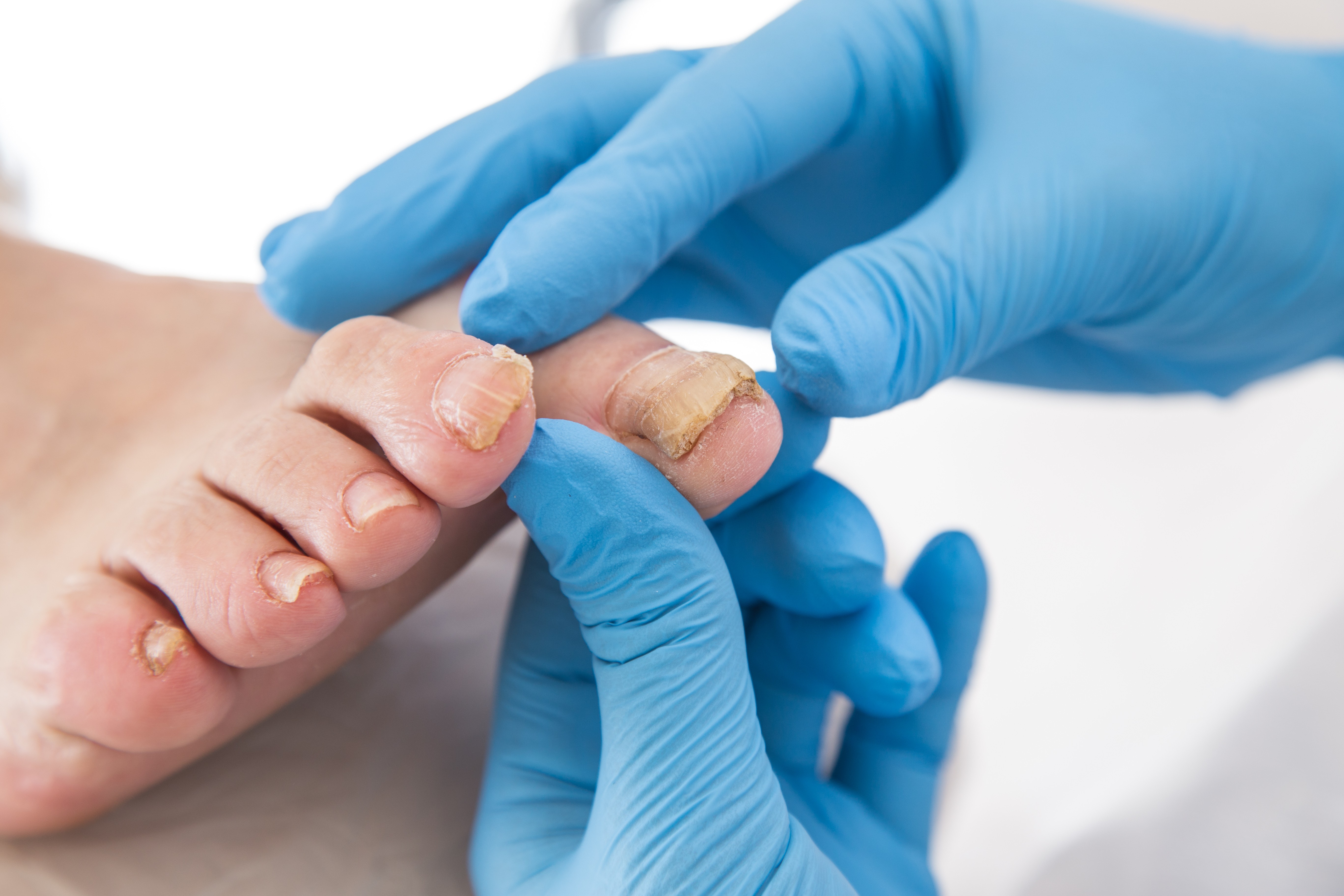 What Is It Like To Have Ingrown Toenail Surgery?