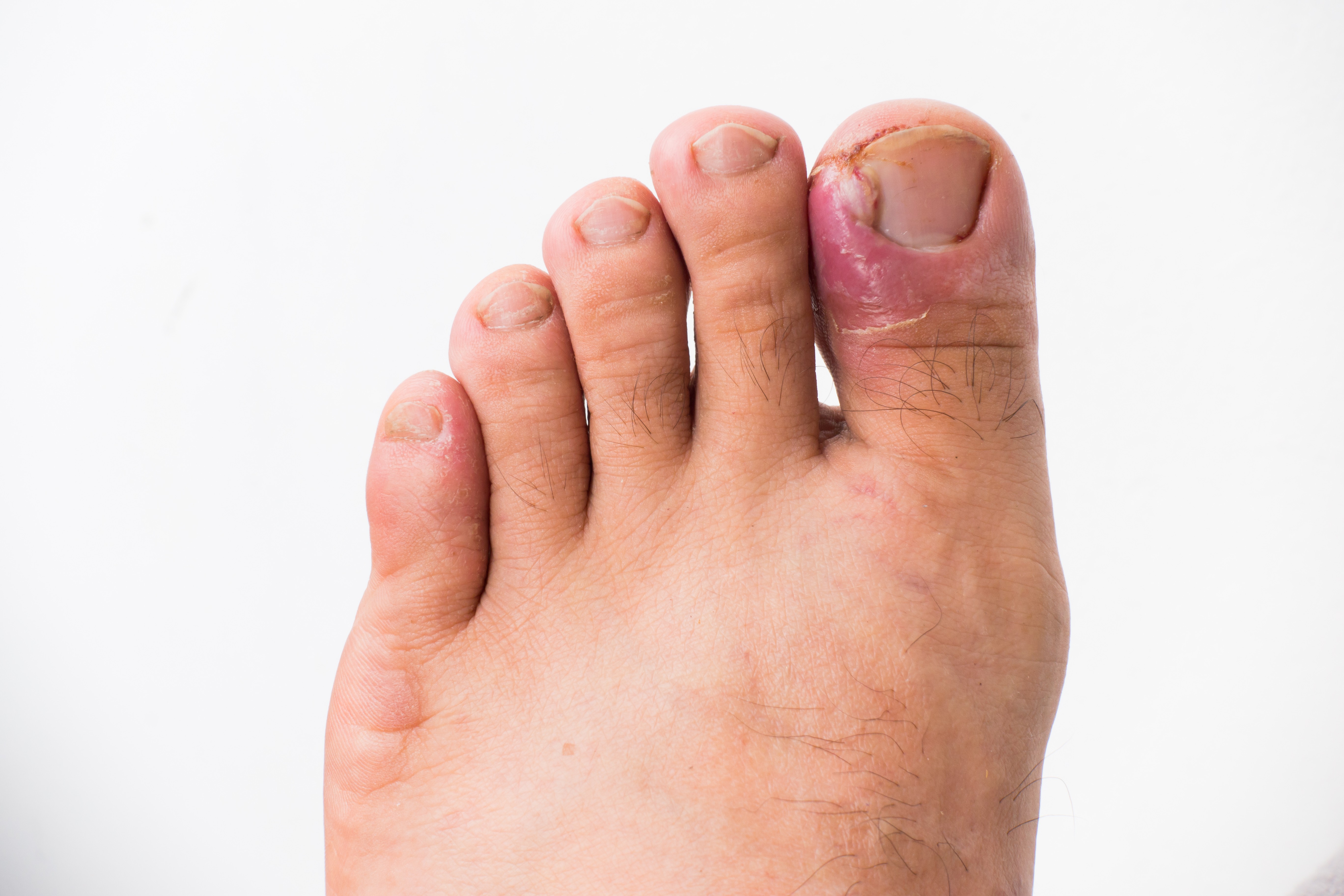 Is Your Ingrown Toenail Oozing Clear or Yellow Pus? It’s Probably Infected