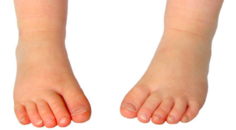 Orthotics for Children: The Gait Plate for In-toeing