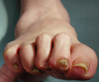 Think you might have a fungal nail infection? Think again.