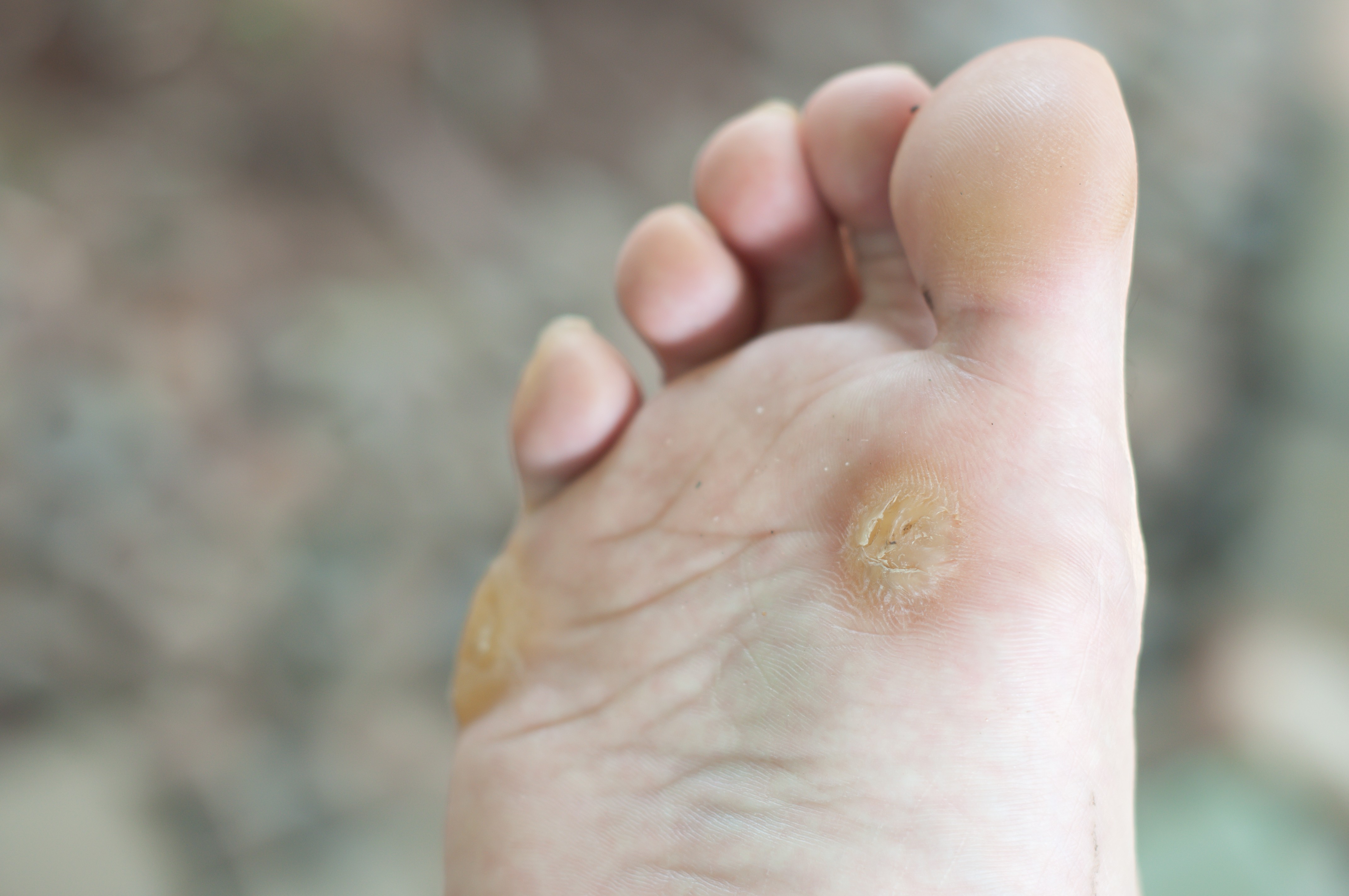 Get Rid Of Painful Corns and Callus &#8211; Instantly!