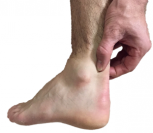 back of heel tendon pain