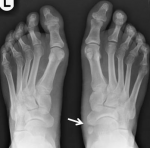 Accessory Navicular Syndrome Perform Podiatry