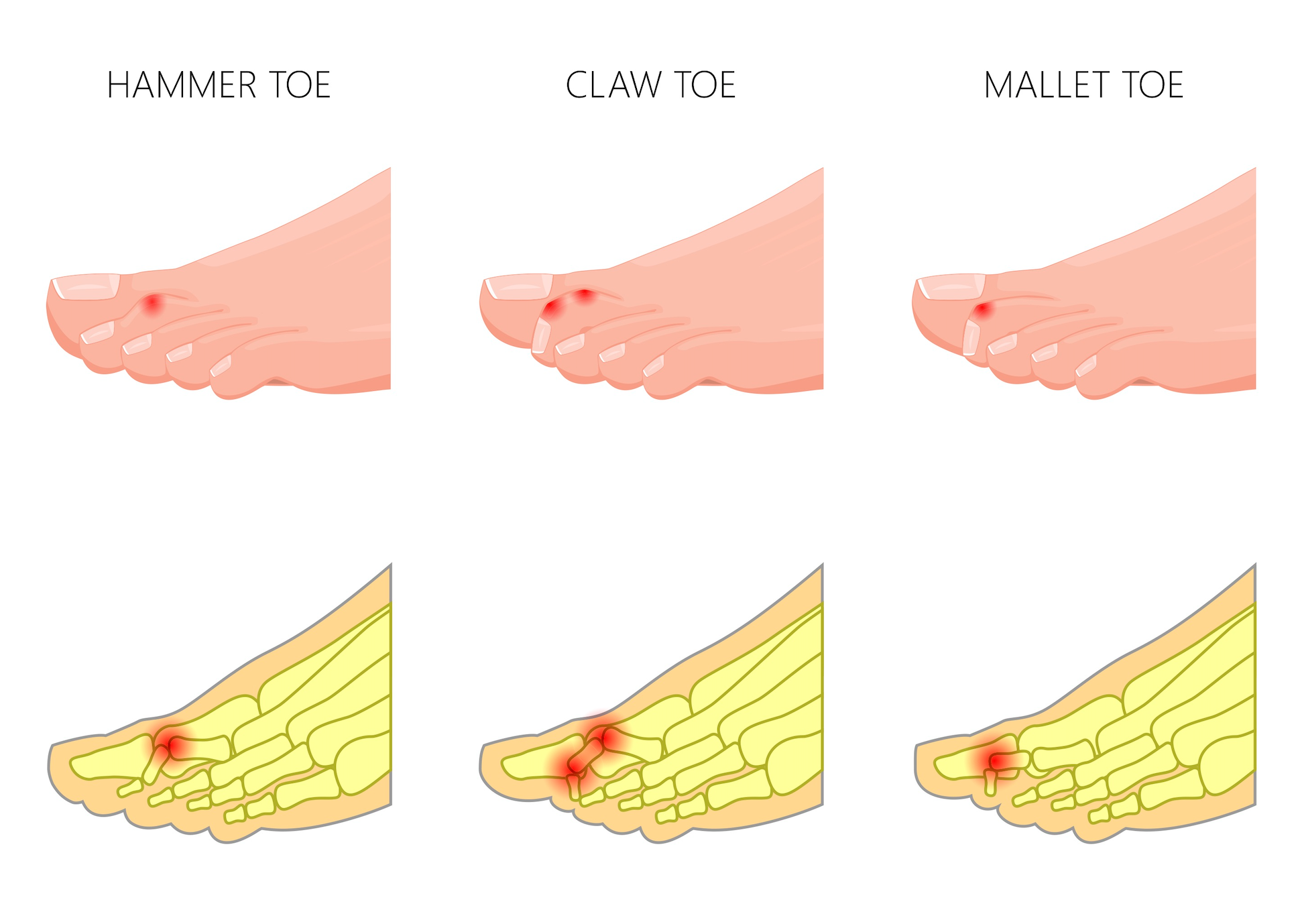 Fixing Curly Toes Hammertoes Claw Toes And Mallet Toes – Perform Podiatry